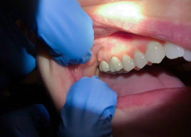 Best Dental Abscess Treatment in Yreka, CA